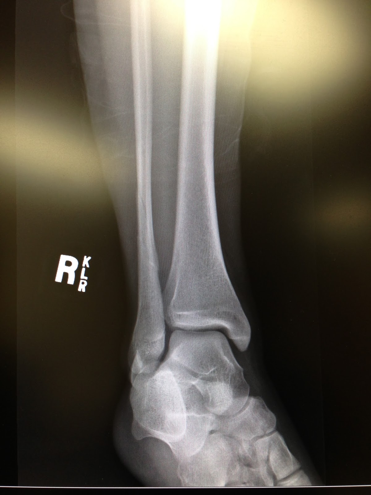 My Broken Ankle The Day I Broke My Ankle