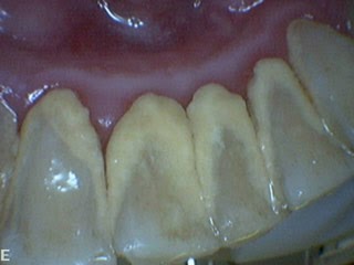dental calculus broke off dental calculus broke off