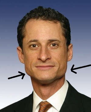 Crystal Lake Dental’s Hot topics: Anthony Weiner photos reveal a bruxer.