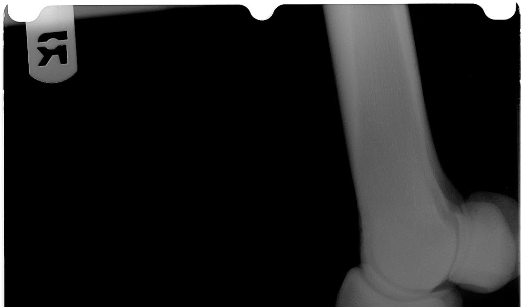 Orange Mocha Frappuccino Diagnosis and Treatment of Pedal Osteitis