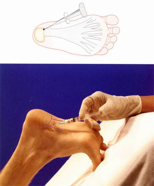 Heel Pain