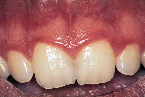 Oral systemic corticosteroids