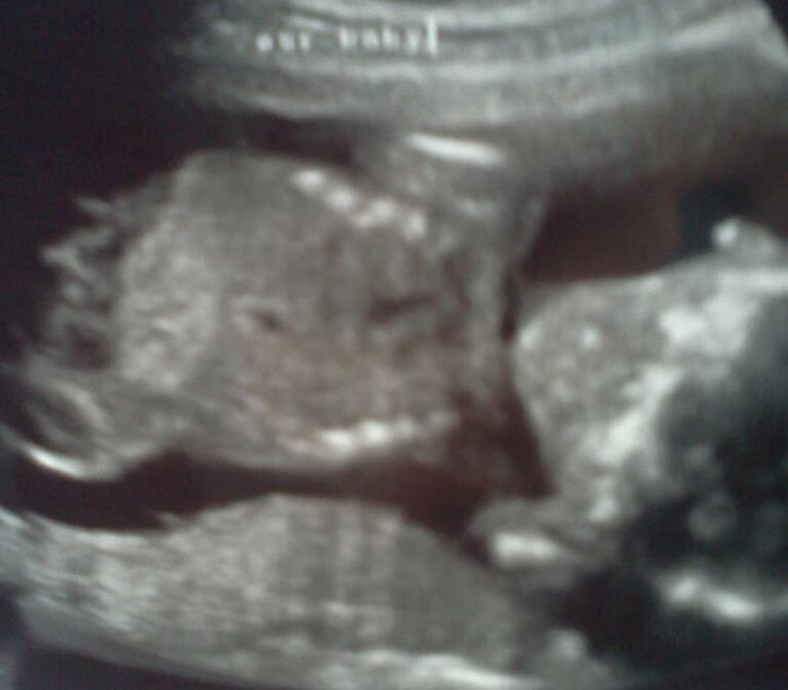 no heartbeat at 6 weeks no heartbeat at 6 weeks