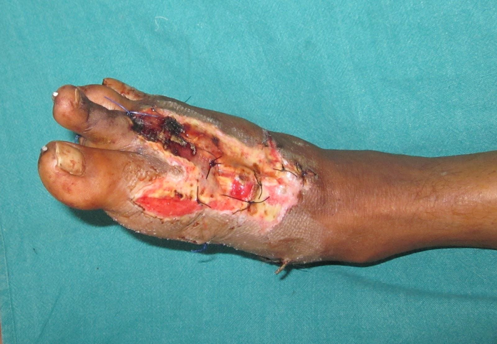 Avulsion Wound