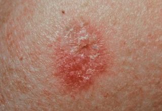 Carcinome basocellulaire Le carcinome basocellulaire est un cancer de la peau dont l'évolution est très favorable sous traitement. Les autres cancers de la peau sont le carcinome spinocellulaire et le → mélanome malin. Épidémiologie Il s'agit du plus fréquent des cancers (près de la moitié des cas) aux États-Unis et son incidence semble s'accroître. Il touche particulièrement les personnes à la peau claire (blonds ou roux) et est corrélé à l'exposition au soleil et aux rayonnements ultraviolets.