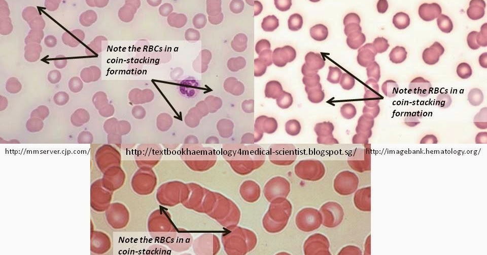 Haematology in a NutShell Rouleaux Formation