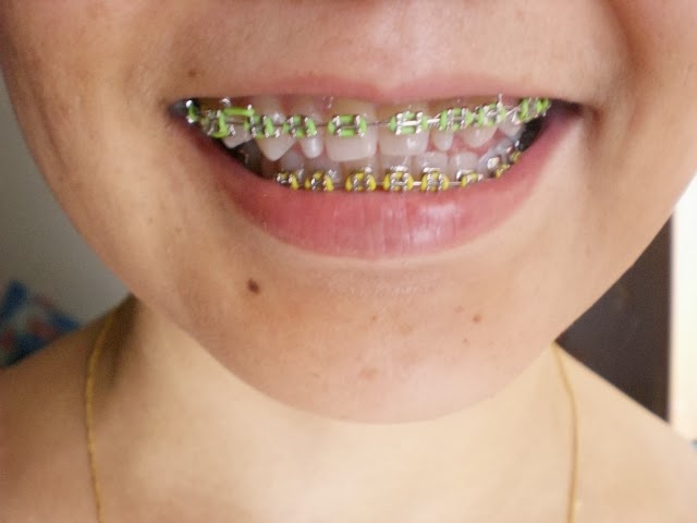 braces yellow bottom boring again
