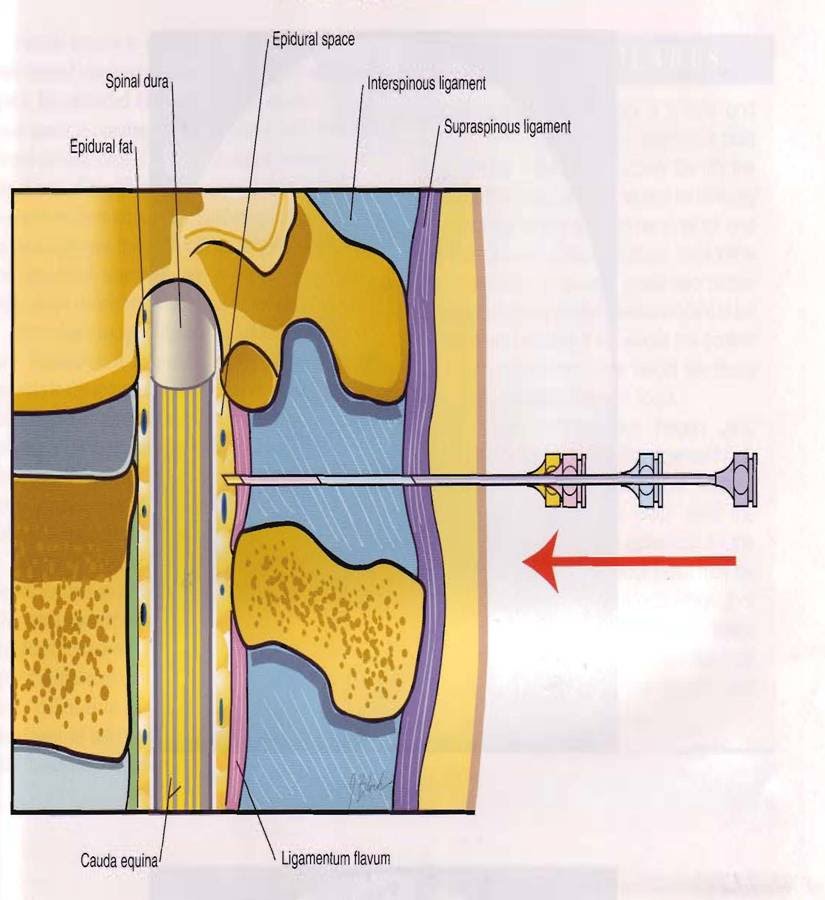 lumbar epidural steroids and breast feeding Busty karina hart photo collection