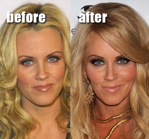 surgery plastic jenny mccarthy before cheek cosmetic fanning implants augmentation dakota botox cheekbone breast celebrity job nose facelift injections face