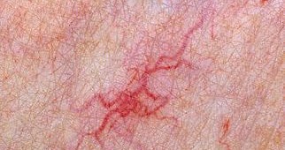 Ur Medstudy FREE Medical MCQs online: MCQ 34 Vasodilation in spider