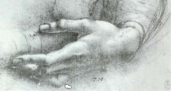 Camptodactyly Treatment