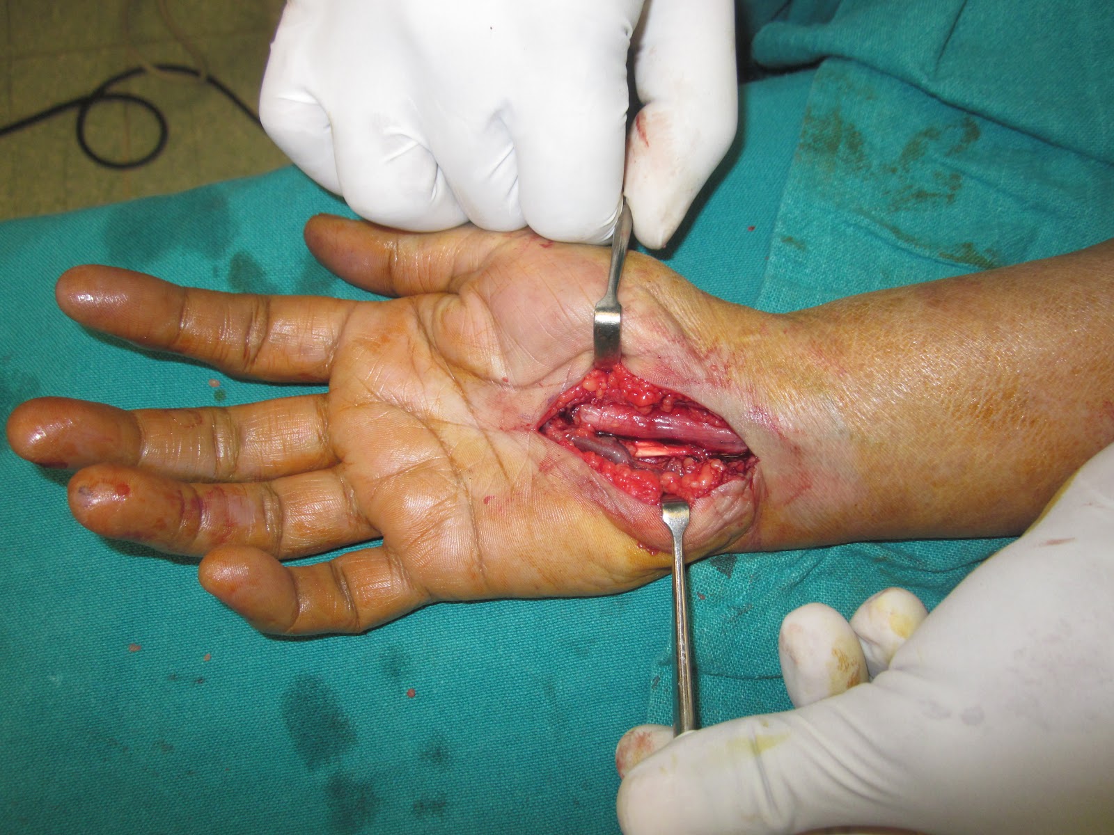 CARPAL TUNNEL SYNDROME SURGICAL RELEASE CARPAL TUNNEL SYNDROME