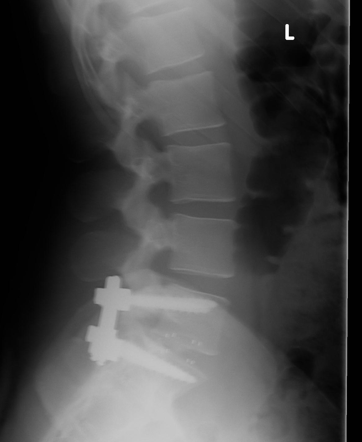 Excuse me...fuse me too!! My story of L5S1 spinal fusion