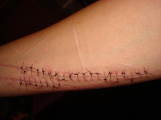 Cutting~ Self-Harm~ Self-Injury Help~ Support~ Treatment~ Bipolar