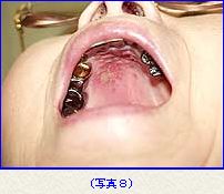 notebook 口唇ヘルペスの画像