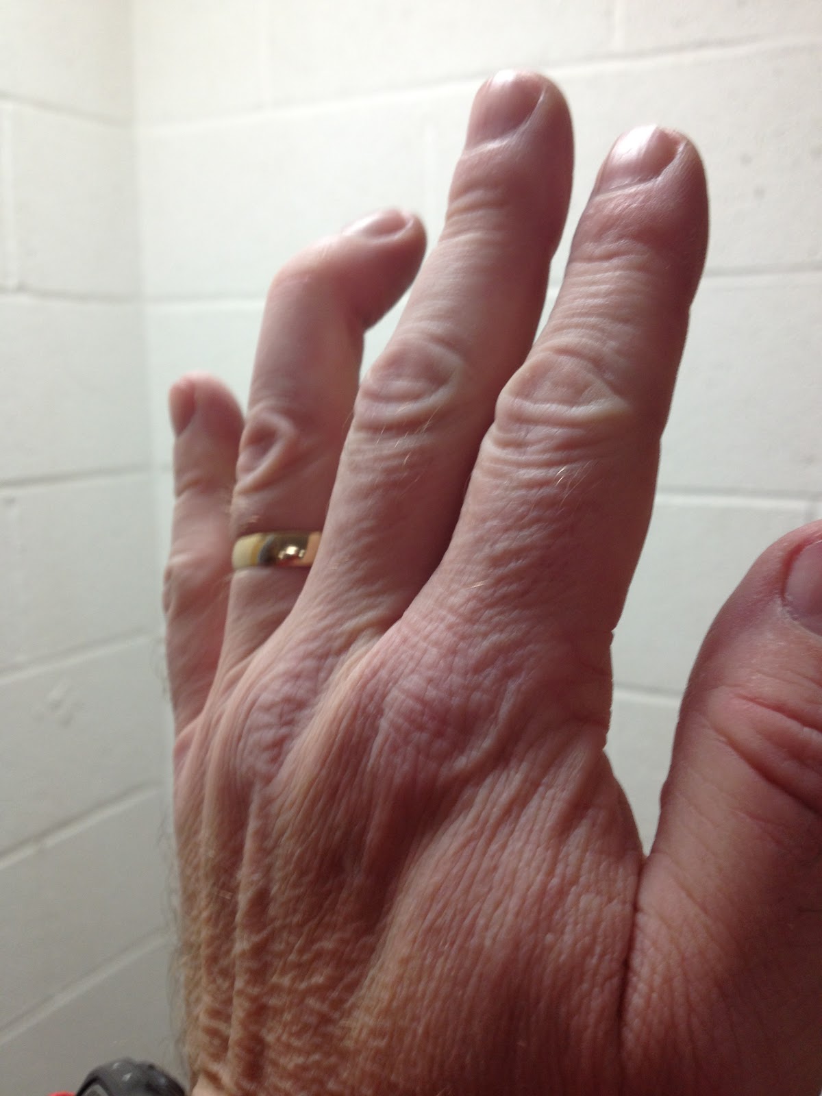 How Hard Can it Be? December Training Update & a broken finger!