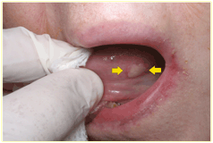 Oral Hpv Natural Treatment Oral Hpv Natural Treatment