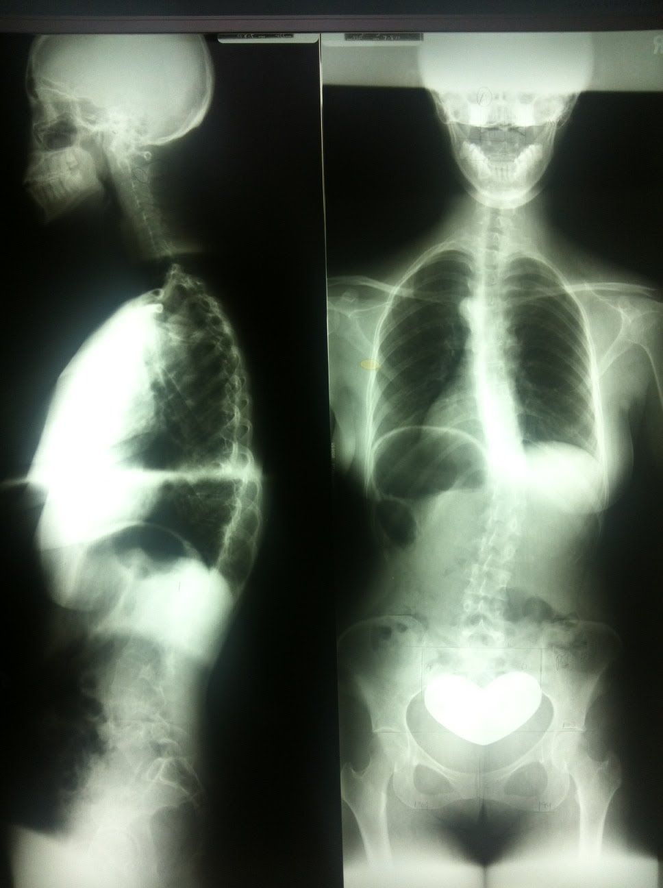 Gonstead New York Wellness Ménière's disease