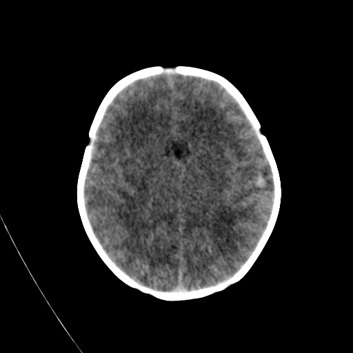 IRRADIATED Radiology Maple Syrup Urine Disease (MSUD)