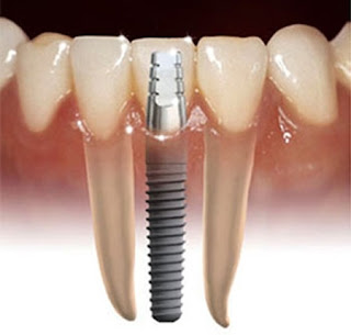 implantes dentales implantes dentales