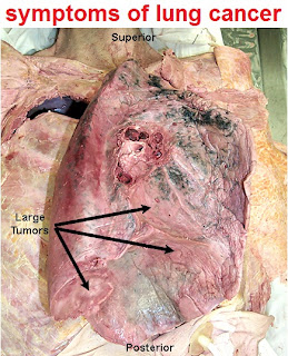 lung cancer pics | image of lung cancer | symptoms of lung cancer picture