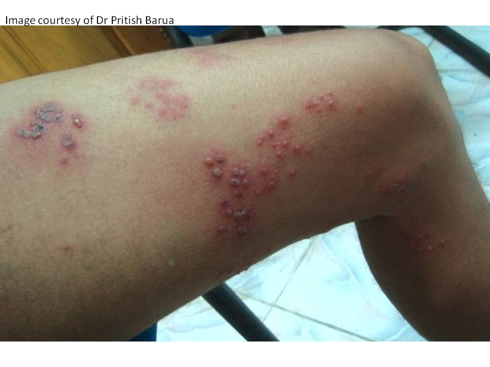 Consultations in Dermatology: A Painful Rash - Herpes Zoster