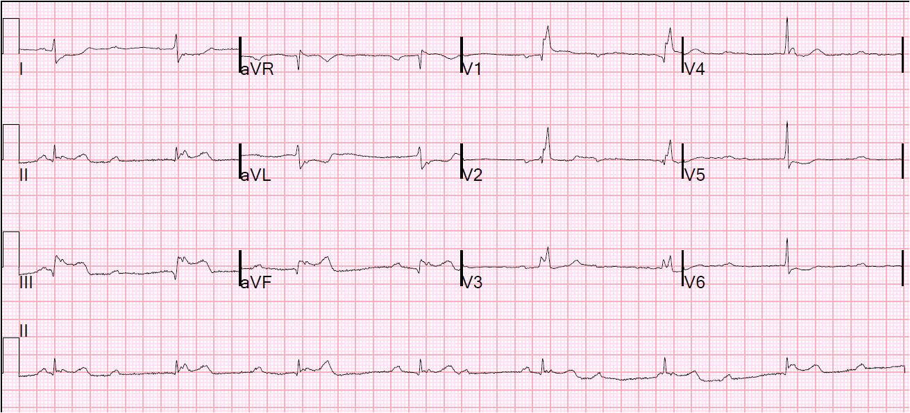 AV block: 3rd degree (complete heart block) • LITFL • ECG Library