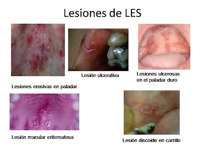 Lupus eritematoso sistemico