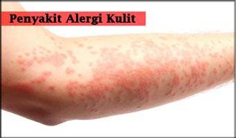 daftar obat obat alergi daftar dosis obat daftar obat obat alergi daftar dosis obat