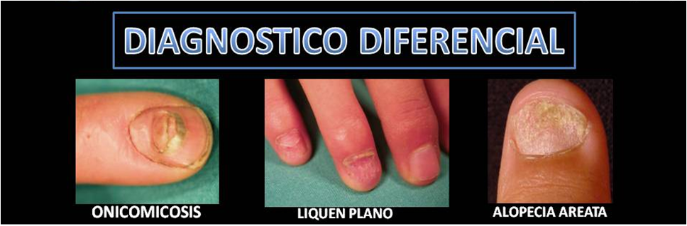 El período de incubación del hongo sobre el alto