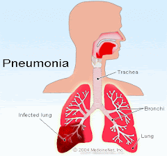 OOF WAREEN PNEUMONIA