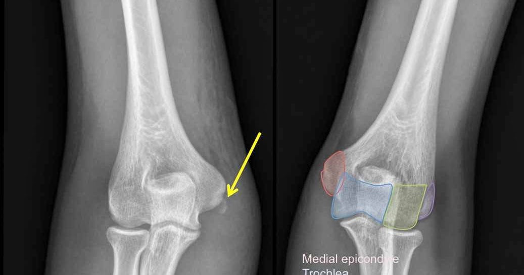 RiT radiology: Medial Epicondyle Fracture of the Humerus