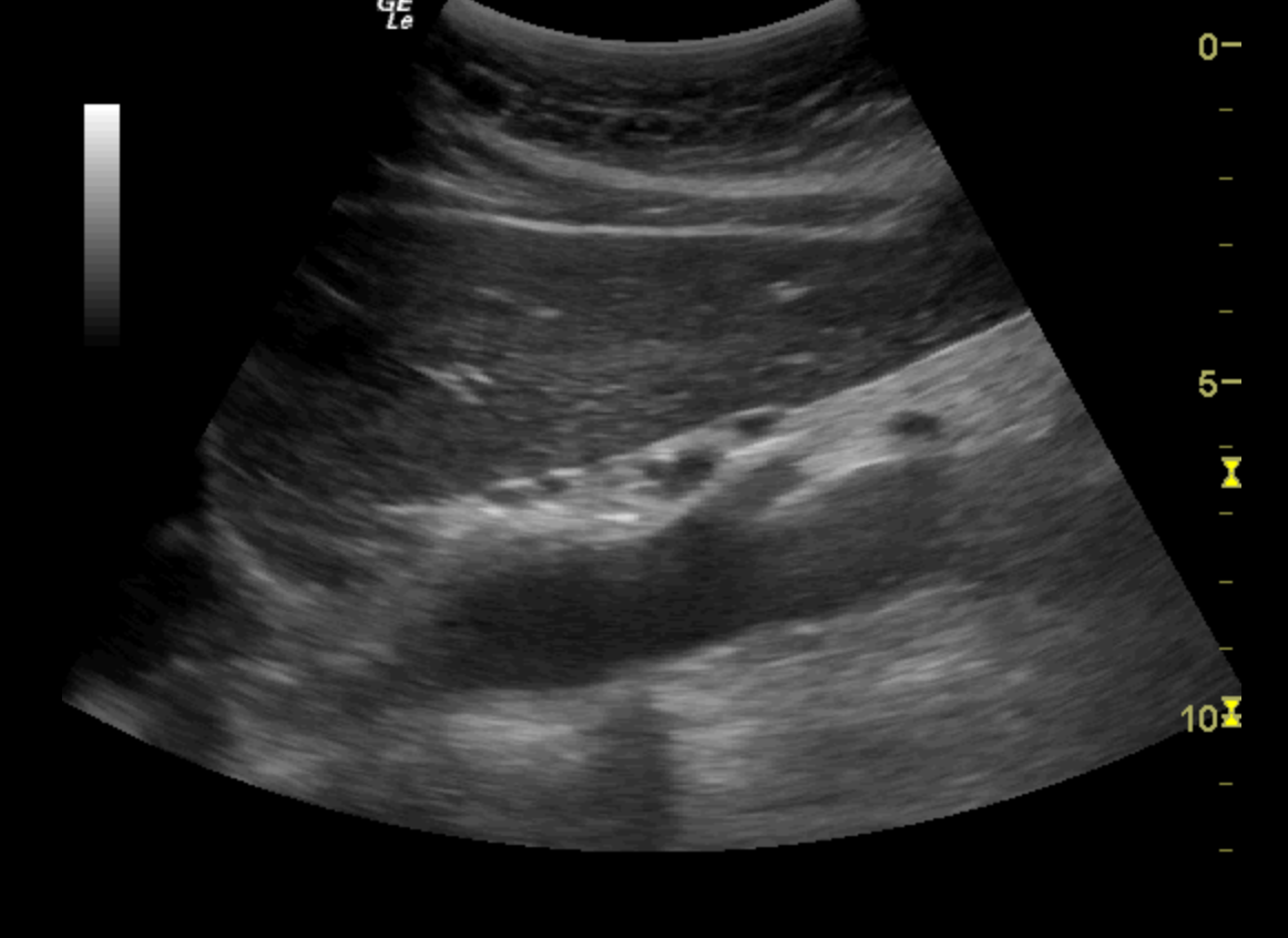 Ultrasound Ninja Aorta