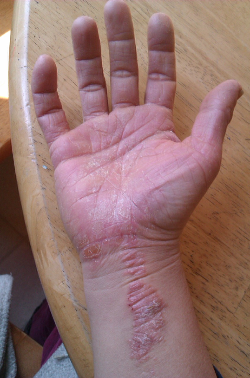 GAPS for Psoriasis Day 16 Psoriasis Update