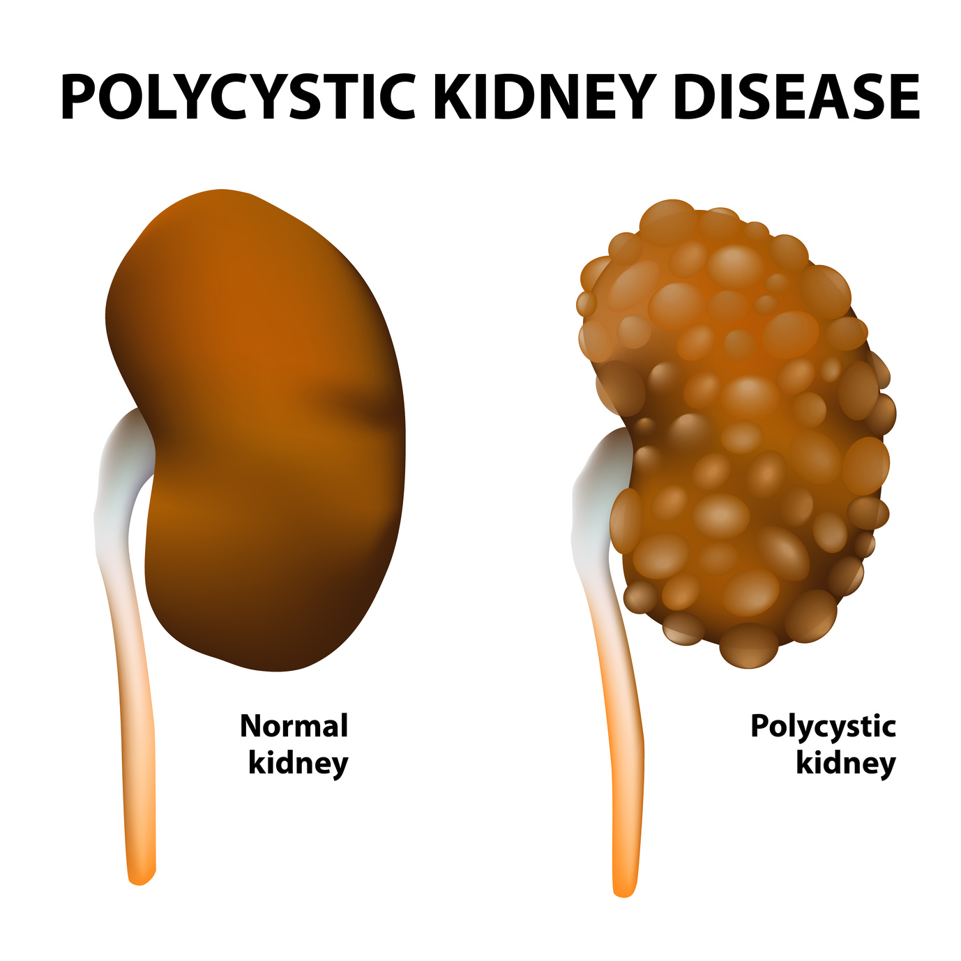 treatment for kidney disease Can I Die of Polycystic Kidney Disease(PKD)?