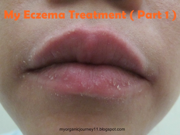 Eczema On Mouth