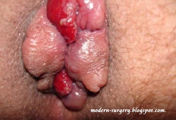 marbelle cantante colombia video porno causes of irritated anus not hemorrhoids
