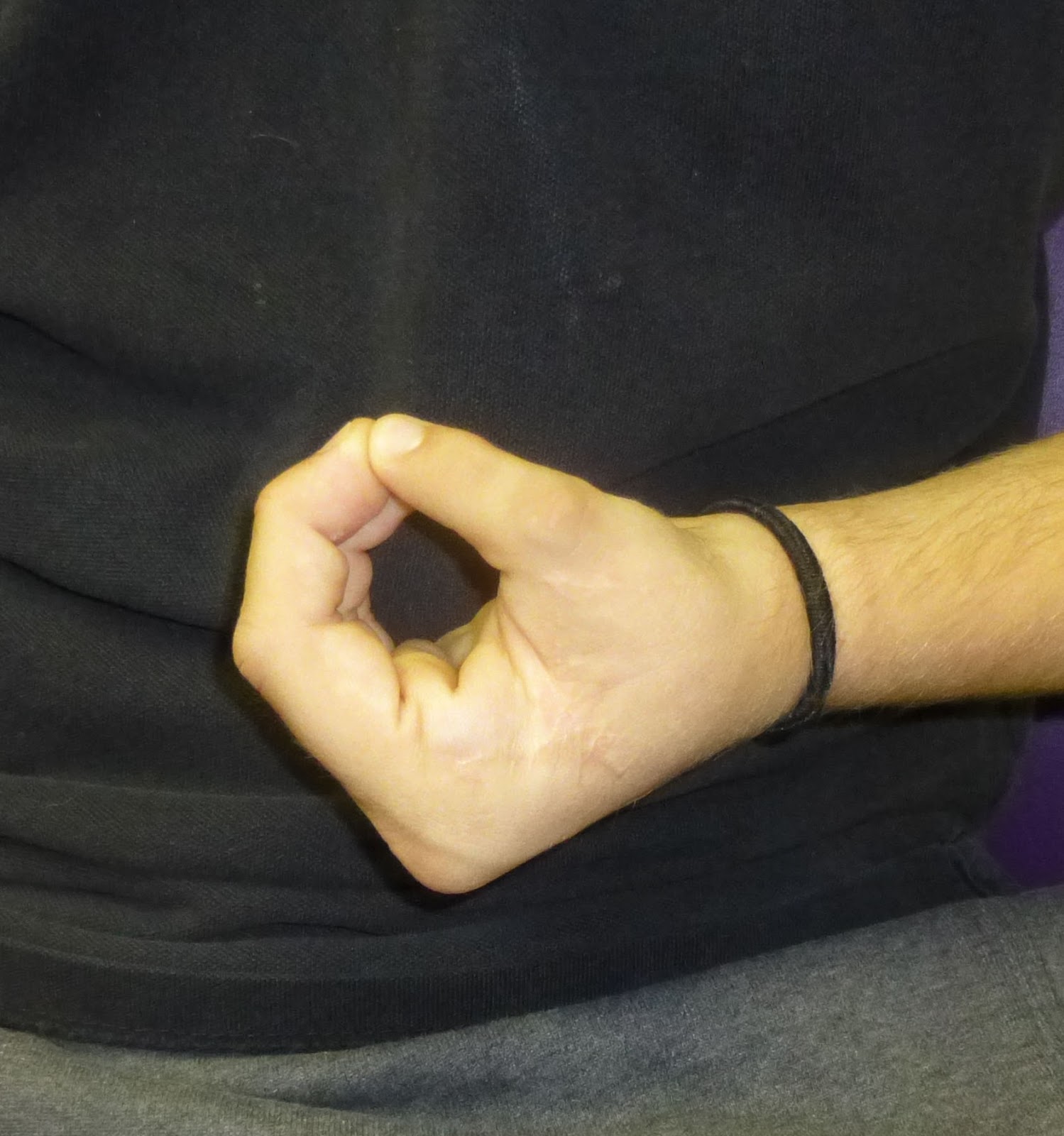 Pollicization at 15 years Congenital Hand and Arm Differences