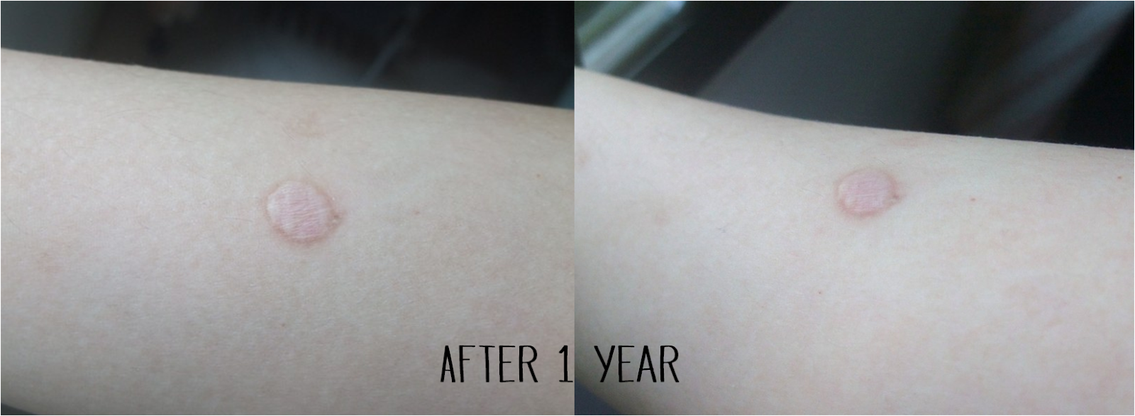 Mole Removal Surgery Part 5 [After 1 year] MyStyleBite