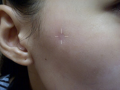 Steroid injection for acne cyst