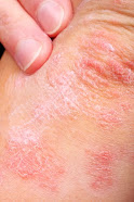 Tratamiento Biológico de la psoriasis, rosácea y acné