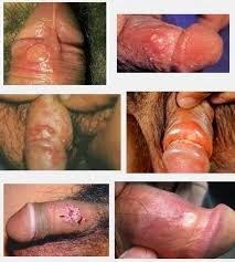 gambar sipilis pria sipilis pria, cara mengobati sipilis, obat sipilis denature