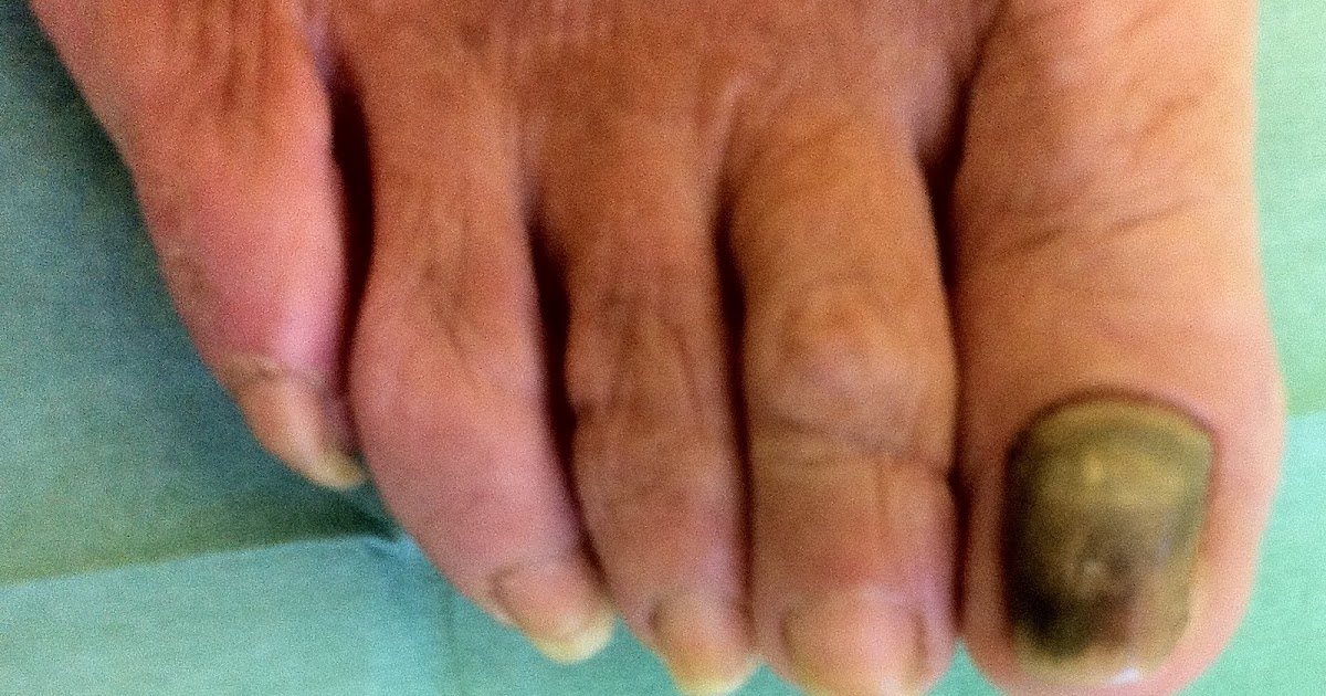 Come guarire la psoriasi sotto unghie