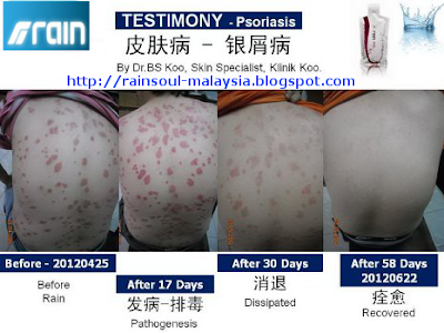 soul rain psoriasis malaysia recovered taking days