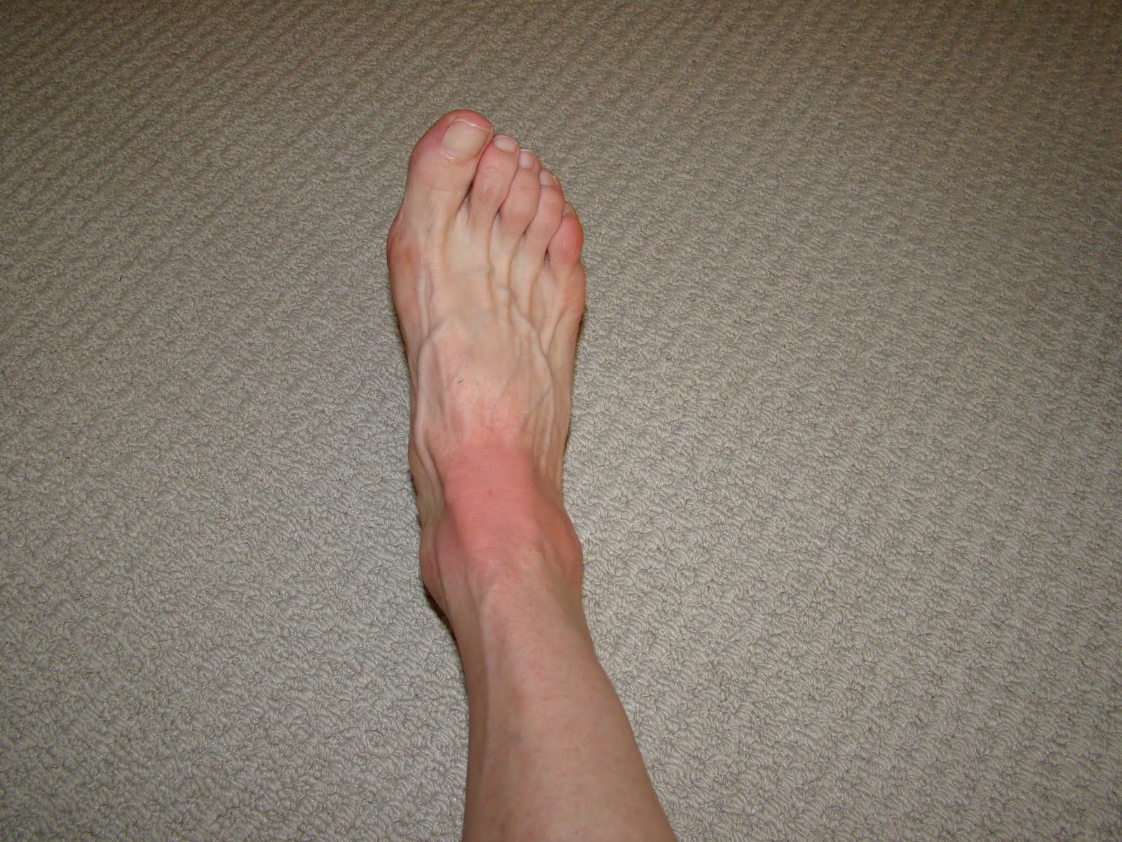 cellulitis yellow jacket sting cellulitis treatment journal