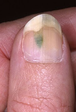 How To Cure Fungus On Fingernails Naturally How To Cure Fungus On Fingernails Naturally
