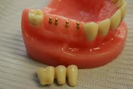 mini implants dentaires prix