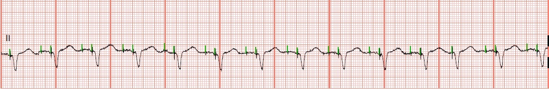 pacemaker av sequential pacemaker av sequential