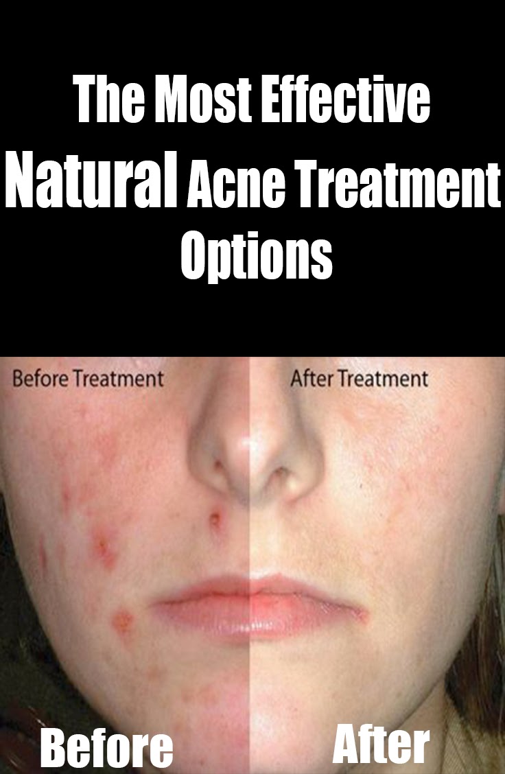 Natural Skin Healing The Most Effective Natural Acne Treatment Option
