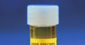 Лечение болезней почек: Почему Там Высокий Белок в моче